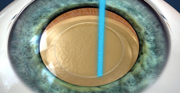 Laser Cataract Surgery2-widget